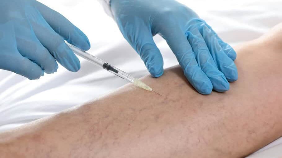 doctor wearing blue gloves inserts a needle into a varicose vein