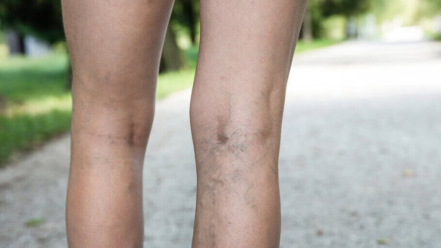 back of woman's legs with substantial varicose veins