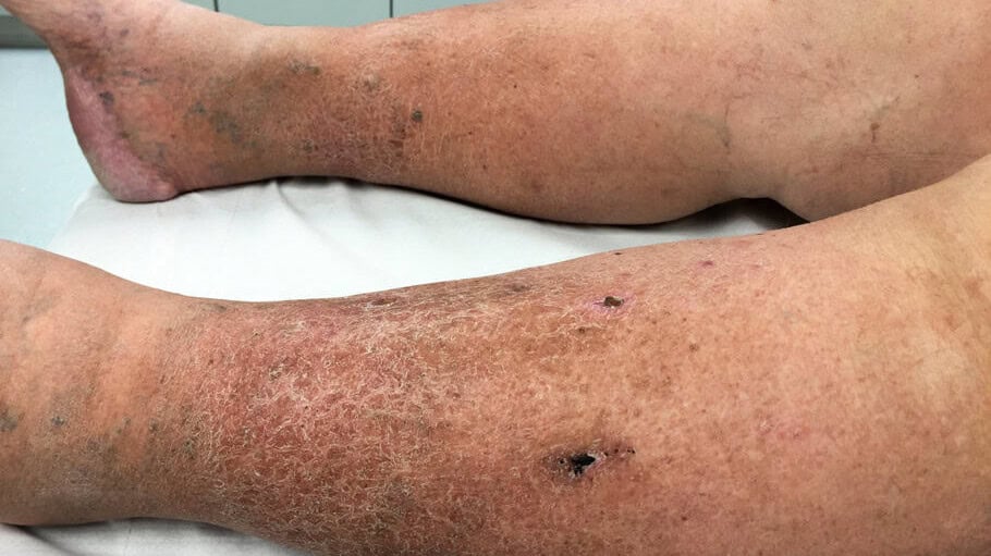 woman with skin changes with hyperpigmentation and impaired wound healing due to chronic venous insufficiency