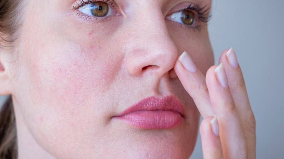 young woman with rosacea on her cheeks