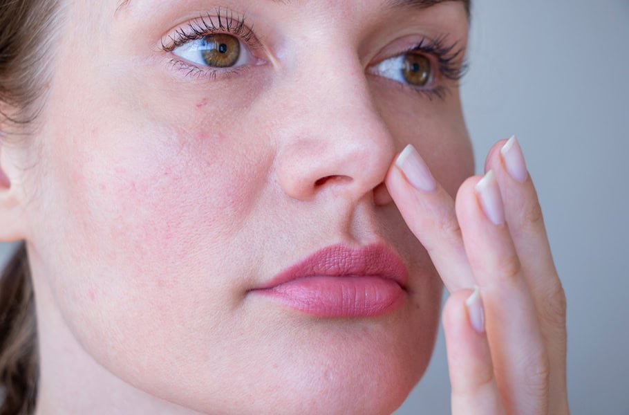 young woman with rosacea on her cheeks