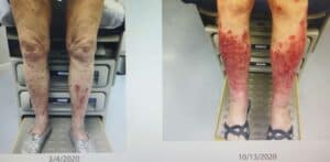 woman's legs with Chronic Venous Insufficiency