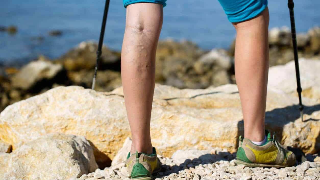 woman with varicose veins hikes using hiking poles