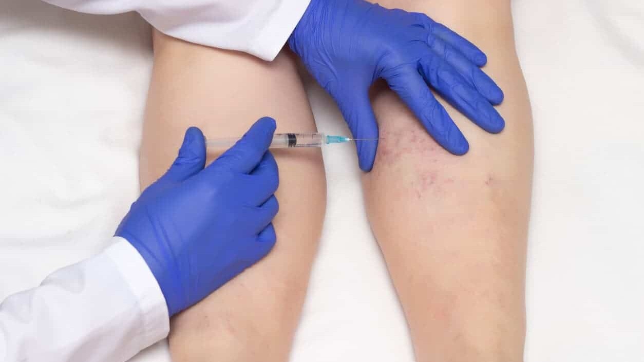 doctor wearing gloves injects a varicose vein on a woman's leg