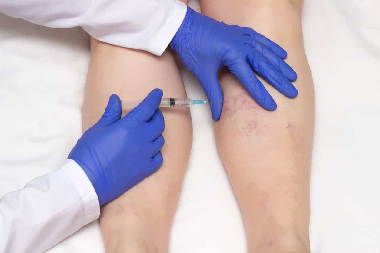 doctor wearing gloves injects a varicose vein on a woman's leg