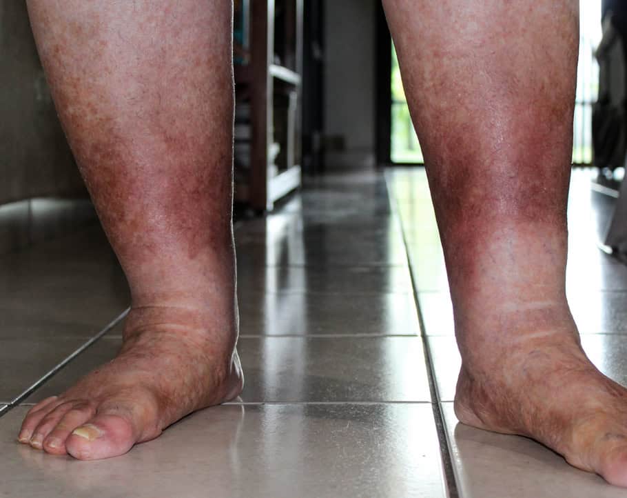 Reddish or brownish skin is a symptom of chronic venous insufficiency