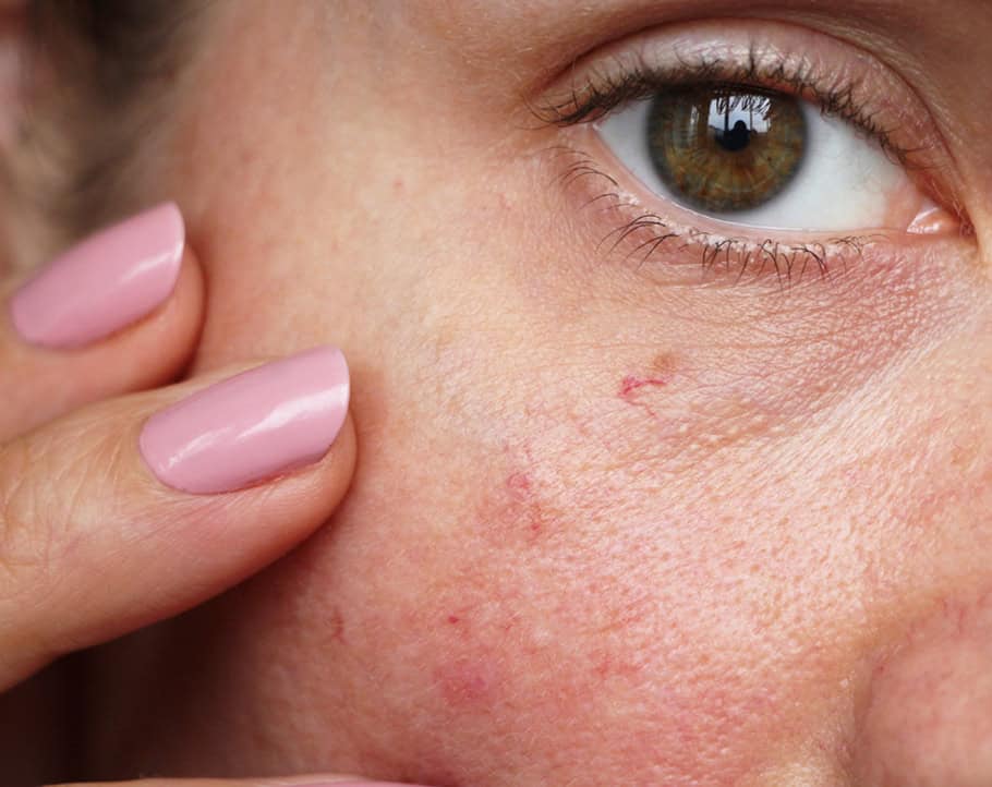 Tiny veins on a woman's face