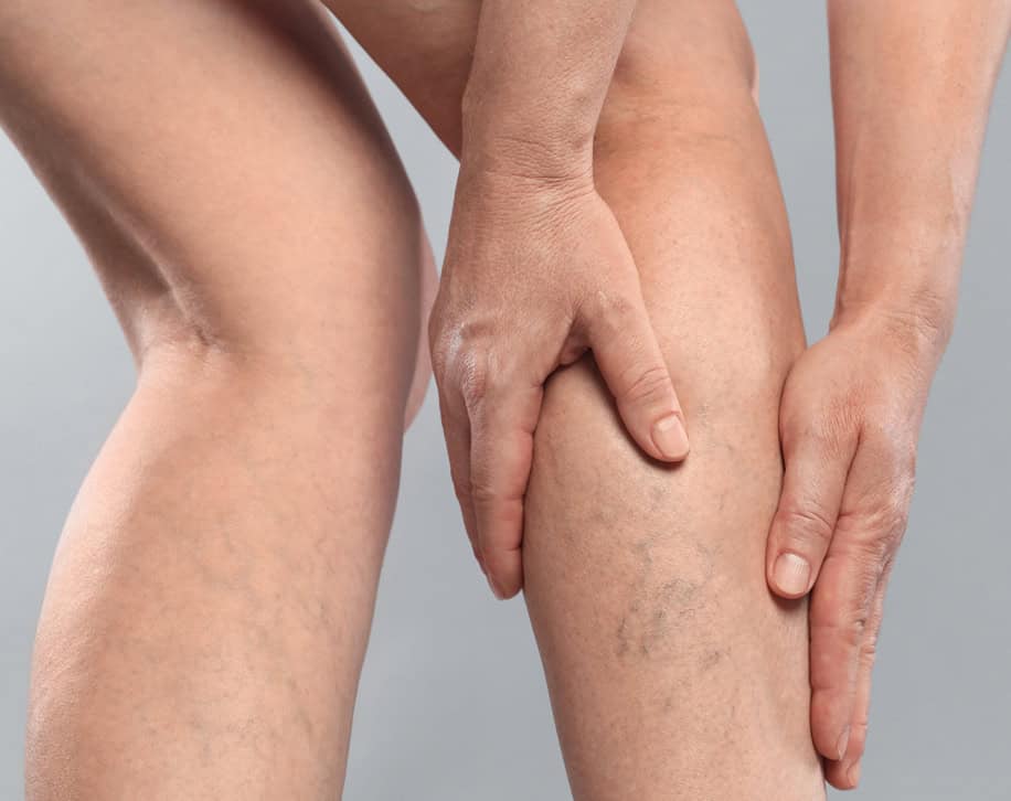 Varicose veins on a woman's legs with her hands on her leg