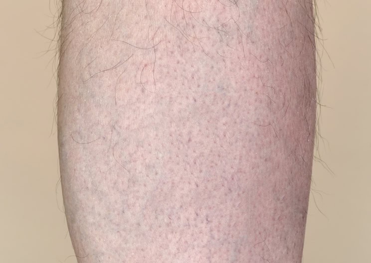 man's calf varicose vein after treatment