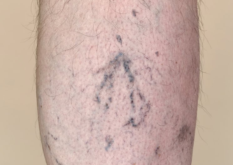 man's calf varicose vein before treatment