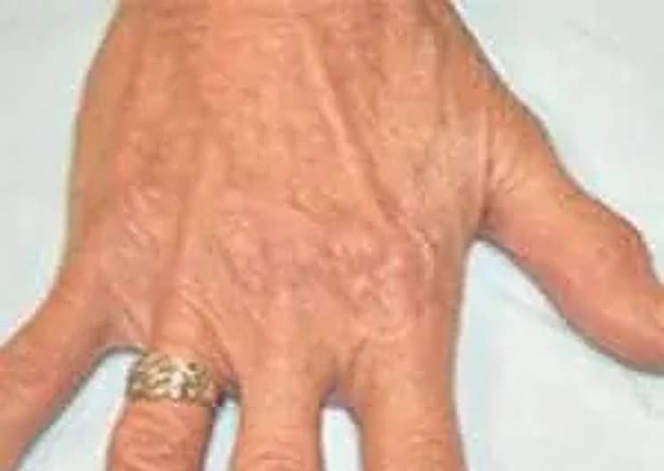 Bulging hand veins on an elderly woman after treatment