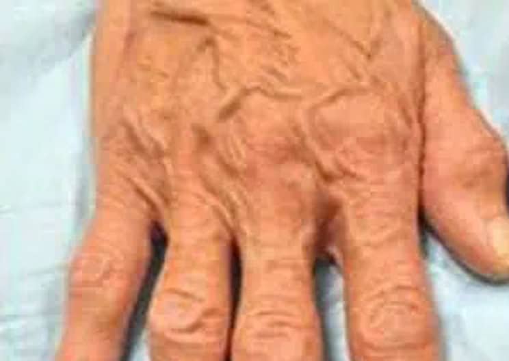 Bulging hand veins on an elderly woman before treatment